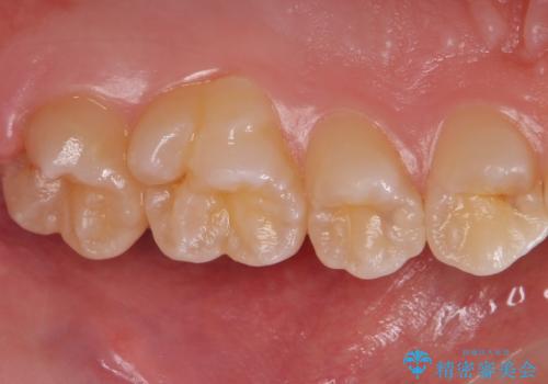 歯と歯の間の虫歯 セラミックインレーでの治療の治療前