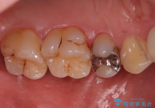銀の詰め物を白くしたい セラミックインレーでの治療の治療前