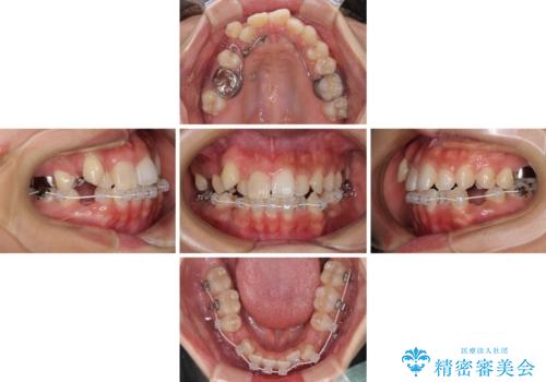 気になる八重歯 目立ちにくいハーフリンガルでの抜歯矯正の治療中