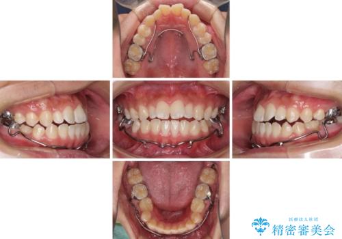 口元の突出感を改善 受け口傾向の咬み合わせの抜歯矯正の治療中