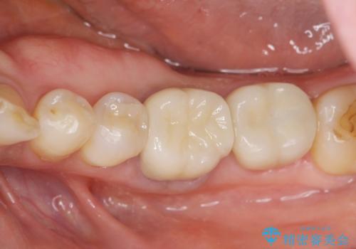 目立つ銀歯を白くしたいの治療後