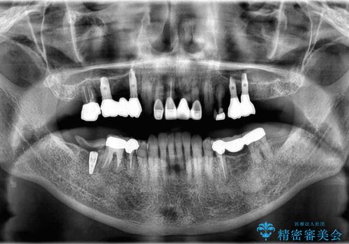 【インプラント】 他院で入れた被せ物が取れたの治療中
