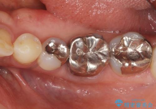 目立つ銀歯を白くしたいの治療前