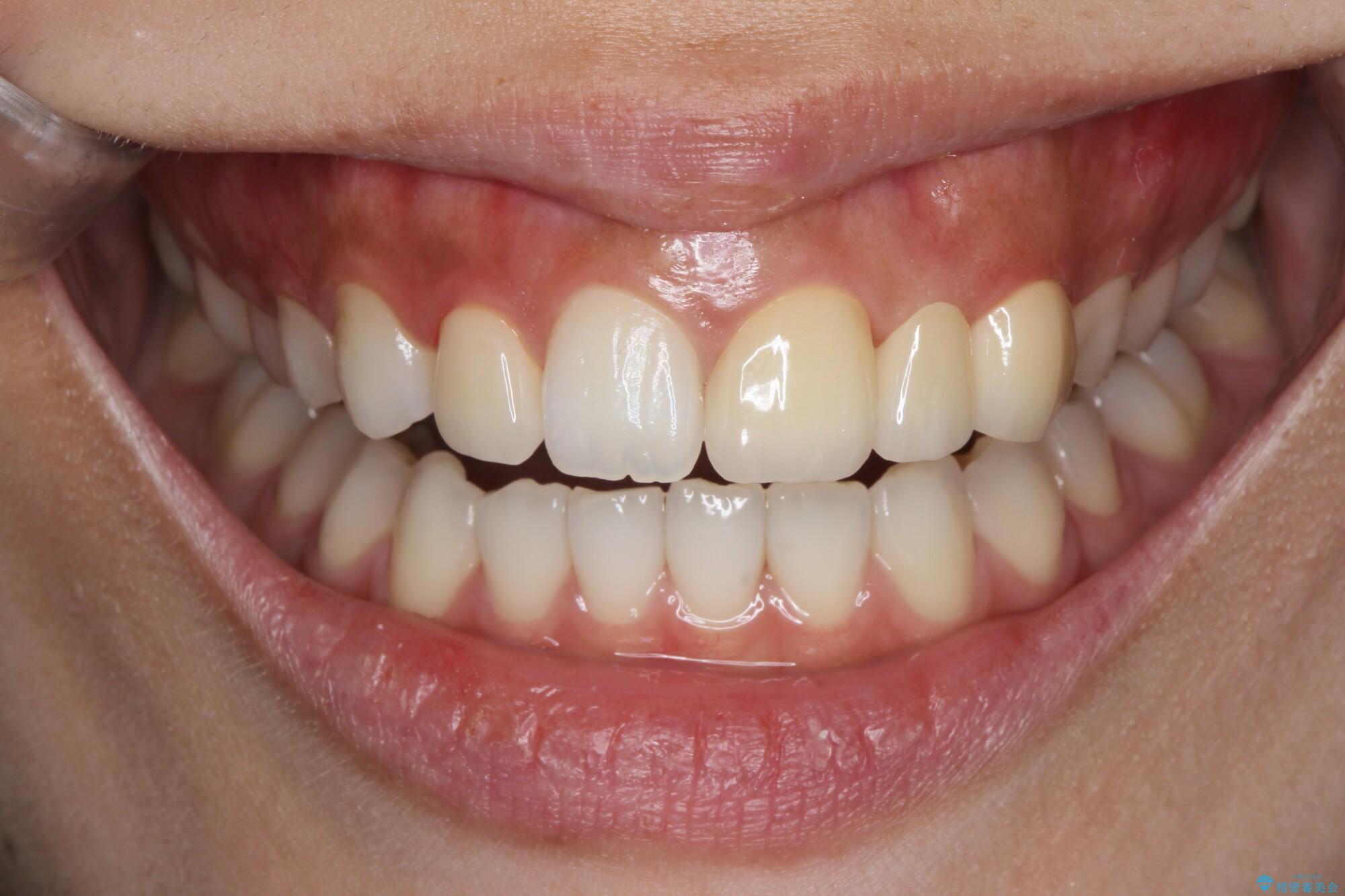 前歯が出っ歯ですきっ歯　抜かずに前歯を見た目良くの治療後（顔貌）