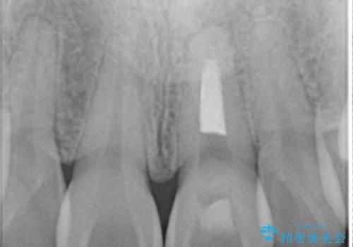 前歯が欠けるの治療前