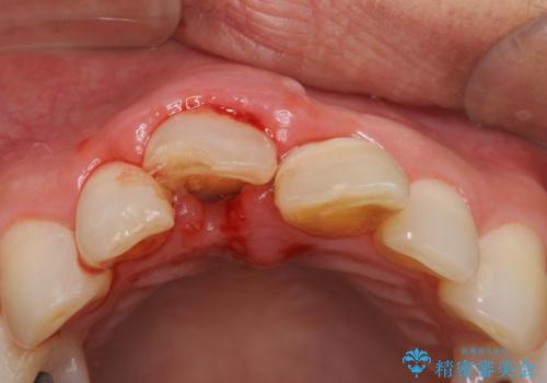 転んで前歯を折った　歯を抜かない治療の治療前