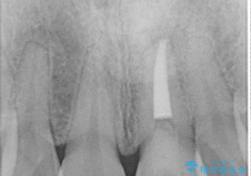 前歯が欠けるの治療後