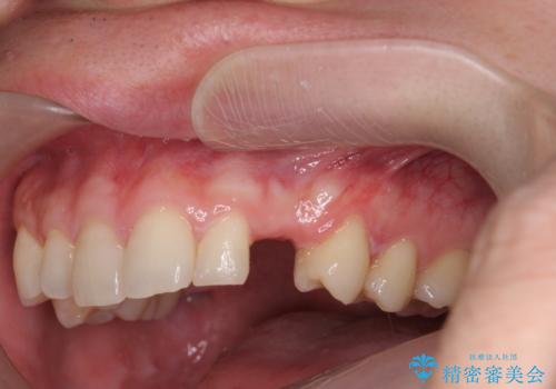 前歯に目立たないノンクラスプデンチャーを作りたいの治療前