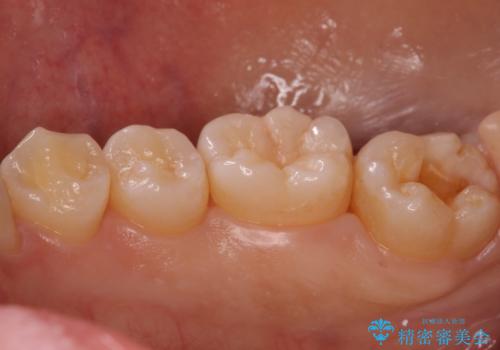 奥歯の黒ずみが気になる セラミックインレーでの治療の治療中