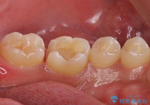 奥歯が欠けた セラミックインレーでの治療の治療中