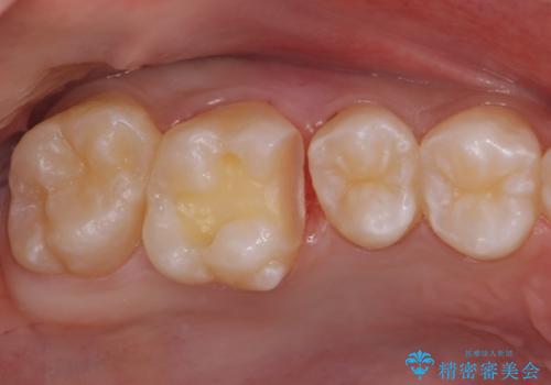 歯と歯の間の虫歯　セラミックインレーでの治療の治療中
