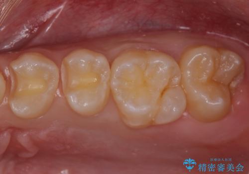 歯と歯の間の虫歯 セラミックインレーでの治療の治療中