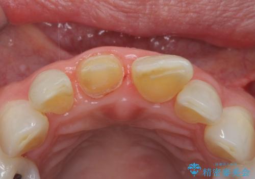 転んで前歯を折った 歯を抜かない治療の治療中