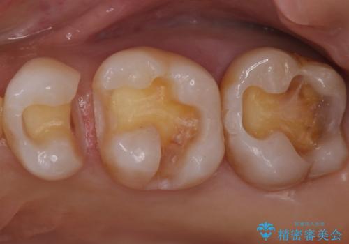 銀歯を白くしたい　セラミックインレーでのやり替えの治療中