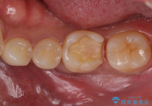 奥歯が欠けた セラミックインレーでの治療の治療中