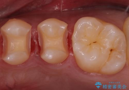 銀歯を目立たなくしたい セラミックインレーでの治療の治療中