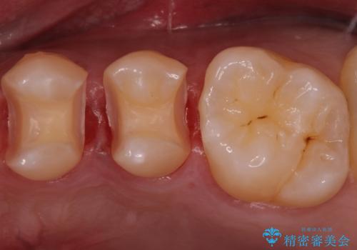 銀歯を目立たなくしたい　セラミックインレーでの治療の治療中