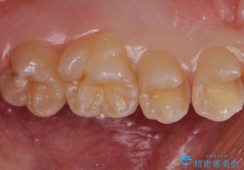歯と歯の間の虫歯 セラミックインレーでの治療の治療中