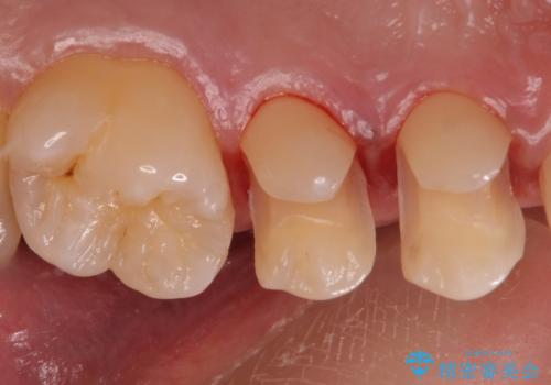 銀歯を目立たなくしたい セラミックインレーでの治療の治療中