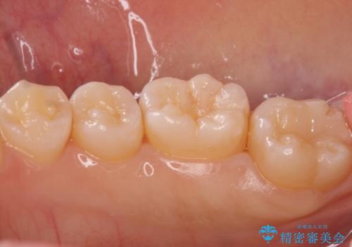 奥歯の黒ずみが気になる セラミックインレーでの治療の治療後