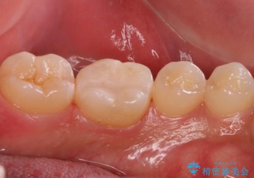 奥歯が欠けた セラミックインレーでの治療の治療後