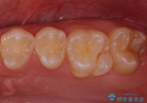 歯と歯の間の虫歯 セラミックインレーでの治療の治療後