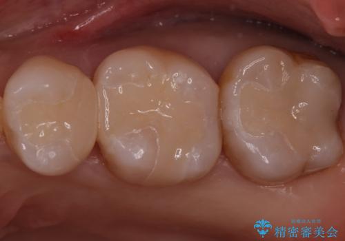 銀歯を白くしたい　セラミックインレーでのやり替えの症例 治療後