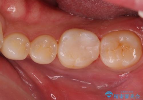 奥歯が欠けた セラミックインレーでの治療の治療後