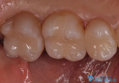 銀歯を白くしたい　セラミックインレーでのやり替えの治療後
