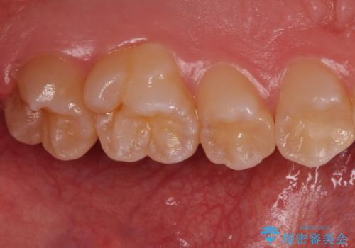 歯と歯の間の虫歯 セラミックインレーでの治療の治療後