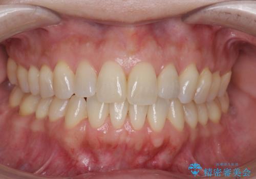 歯のすり減りと歯の挺出をナイトガードで予防の治療前