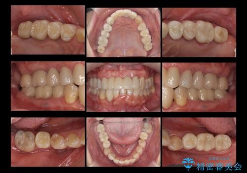 全体的な歯周病治療 包括治療の治療後