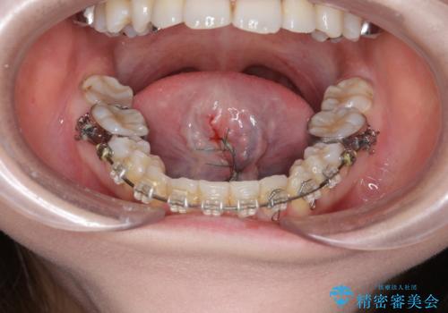 滑舌を改善! 舌小帯の形成術の治療中