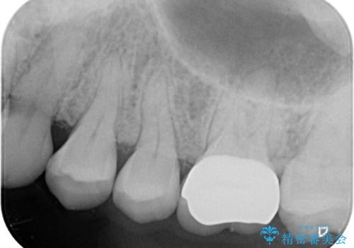 【セラミッククラウン】メタルフリー治療の治療後