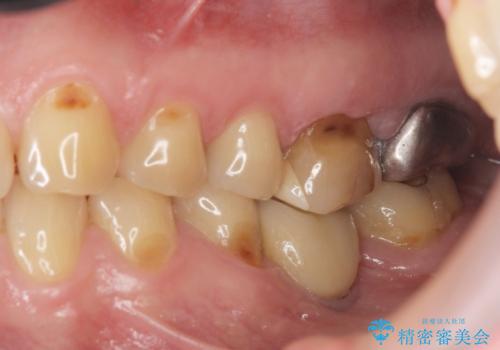 奥歯から臭いがする 銀歯下の虫歯再発の治療前