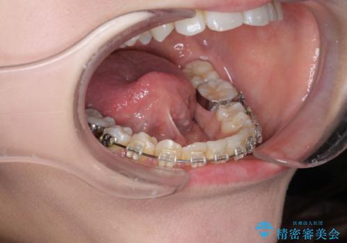 滑舌を改善!　舌小帯の形成術の治療前