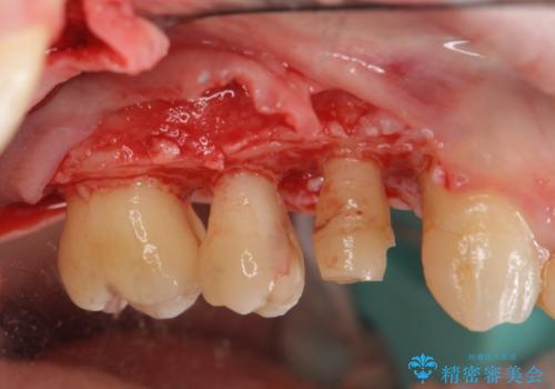 [ 歯肉縁下齲蝕 ]  歯周外科を行った虫歯治療の治療中