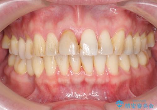 前歯の変色を改善!セラミック治療の治療前
