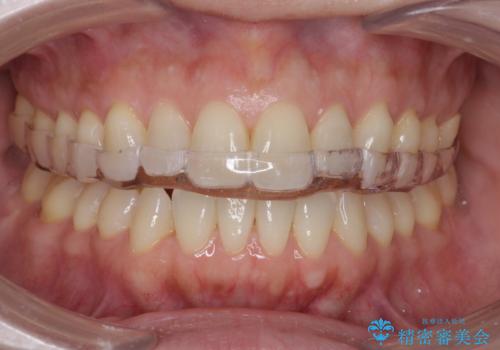 歯のすり減りと歯の挺出をナイトガードで予防の治療後
