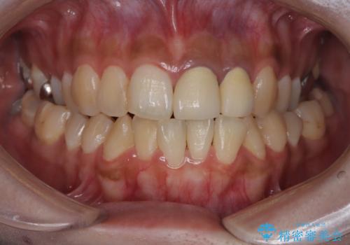 前歯の歯茎の黒ずみと被せ物の形と色が気になる【オールセラミッククラウン】の治療前