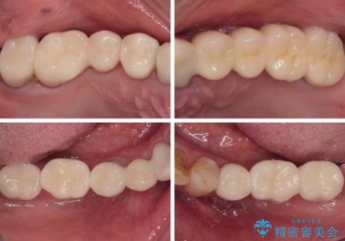 放置したインプラントとインビザライン 全顎リカバリー治療の治療後
