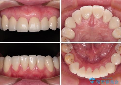 むし歯だらけの前歯をオールセラミッククラウンできれいにの治療後