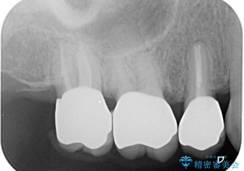 【オールセラミッククラウン】メタルフリー治療の治療後