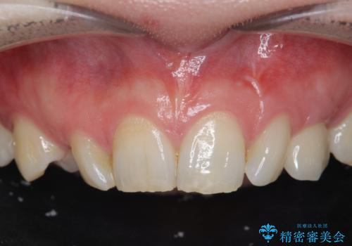 骨造成を伴う 前歯部インプラント治療の治療後