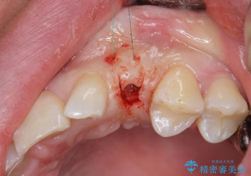 骨造成を伴う 前歯部インプラント治療の治療中