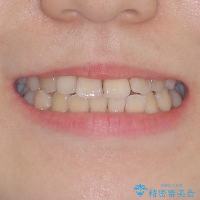 虫歯治療ついでに歯並びの後戻りを改善　インビザラインによる矯正治療の治療前（顔貌）
