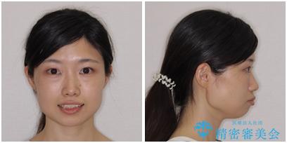 【モニター】口が閉じにくい 抜歯矯正で口元を引っ込めるの治療前(顔貌)