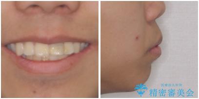 膨らんだ口元 ワイヤー装置での抜歯矯正の治療前(顔貌)