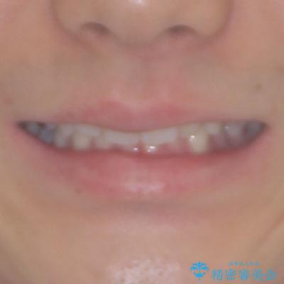インビザラインによる矯正治療と奥歯のインプラント治療の治療前（顔貌）