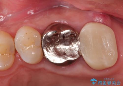 【歯牙破折】インプラントによる咬合回復の症例 治療前